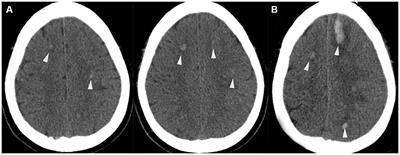 Complex torcular dural arteriovenous fistula leading to cortical venous reflux-induced severe varix and subsequent bilateral cerebral hemispheric hemorrhage: a case report